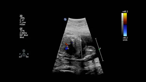 Ecrã Ultrassonográfico Com Ecocardiografia Fetal — Fotografia de Stock