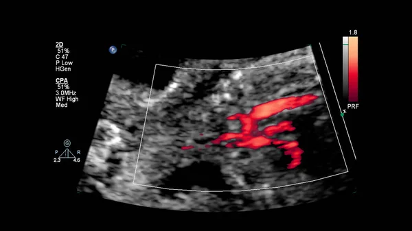 Ecrã Ultrassonográfico Com Ecocardiografia Fetal — Fotografia de Stock