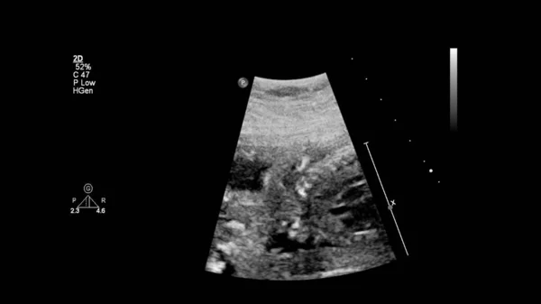 Ecrã Ultrassonográfico Com Ecocardiografia Fetal — Fotografia de Stock