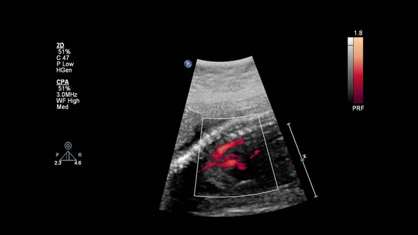 Echografie Scherm Met Foetale Echocardiografie — Stockfoto