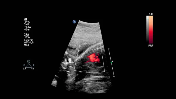 Ecrã Ultrassonográfico Com Ecocardiografia Fetal — Fotografia de Stock