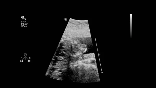 Ecrã Ultrassonográfico Com Ecocardiografia Fetal — Fotografia de Stock