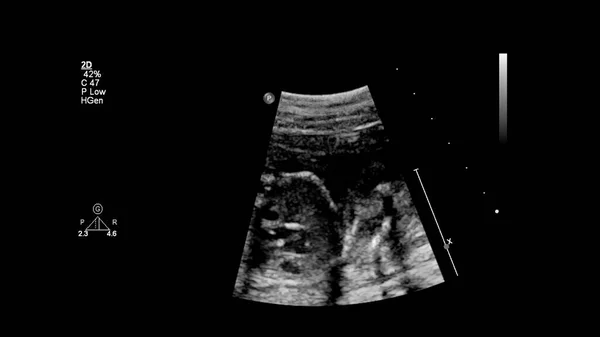 Echografie Scherm Met Foetale Echocardiografie — Stockfoto