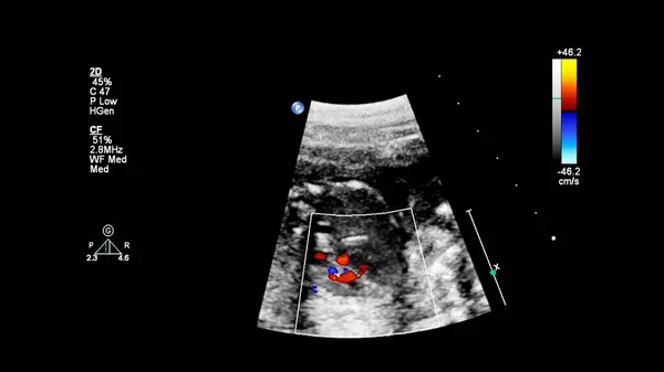 Ecrã Ultrassonográfico Com Ecocardiografia Fetal — Fotografia de Stock