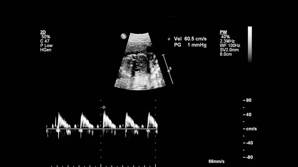 Ecrã Ultrassonográfico Com Ecocardiografia Fetal — Fotografia de Stock