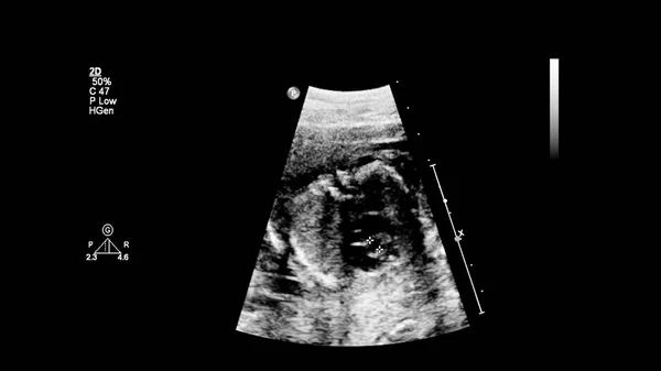 Ecrã Ultrassonográfico Com Ecocardiografia Fetal — Fotografia de Stock