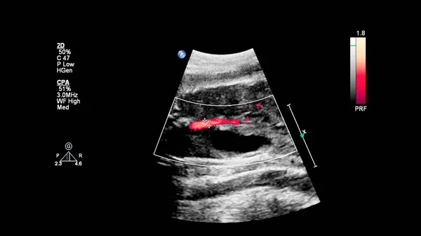 Ecrã Ultrassonográfico Com Ecocardiografia Fetal — Fotografia de Stock