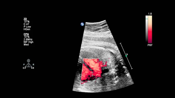 Ecrã Ultrassonográfico Com Ecocardiografia Fetal — Fotografia de Stock