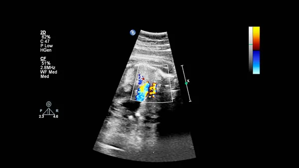 Ultrasound Screen Fetal Echocardiography — Stock Photo, Image