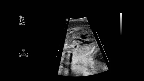 带胎儿超声心动图的超声屏幕 — 图库照片