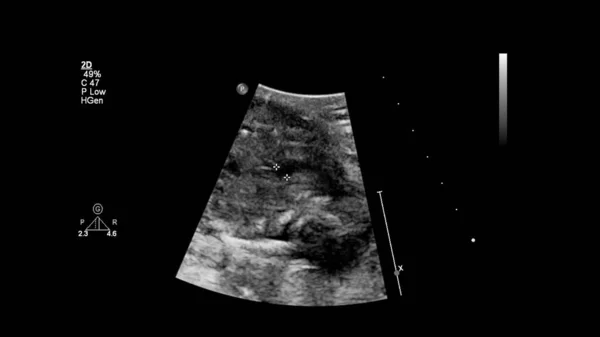 Ecrã Ultrassonográfico Com Ecocardiografia Fetal — Fotografia de Stock