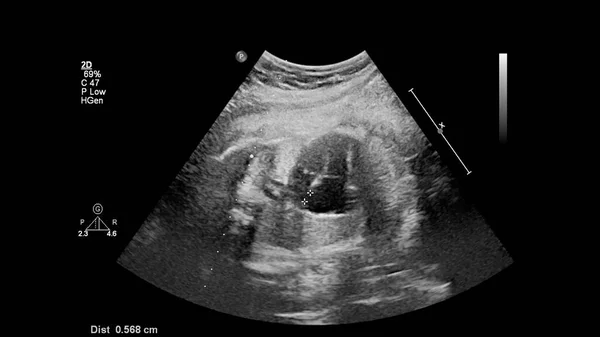 증후군으로 태아의 심장을 초음파 검사하는 스톡 사진