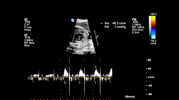 Fetal Ekokardiyografi Ile Ultrasonografi Ekranı Stok Fotoğraf