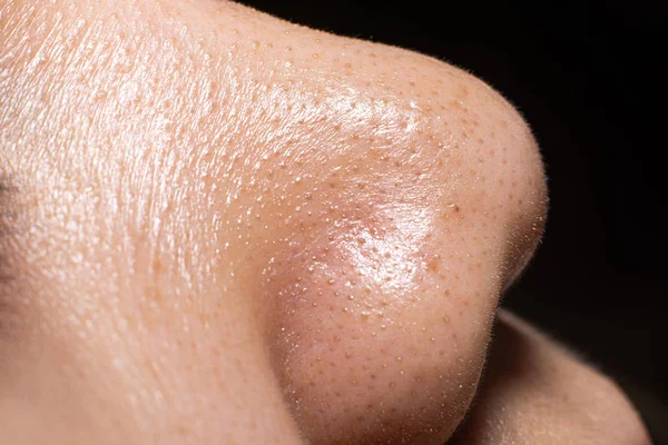 Nahaufnahme Frauen zeigen die kleinen Pickel Mitesser auf der Haut der Nase. — Stockfoto