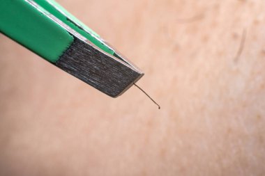 Close up using tweezers to remove hair from armpit.