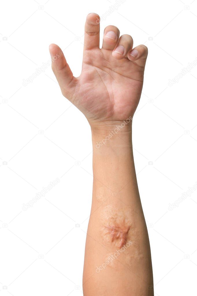 Man arm and hand with Keloid scar (Hypertrophic Scar) on skin after accident isolated on white background.