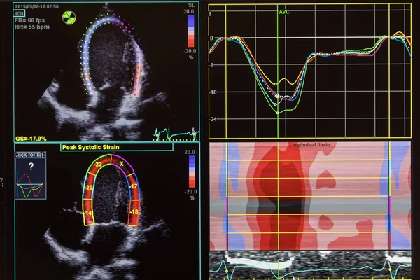 コンピューターの画面上の心臓超音波画像. — ストック写真