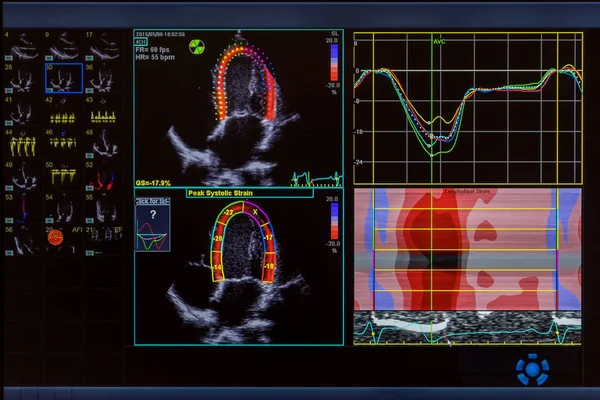 コンピューターの画面上の心臓超音波画像. — ストック写真