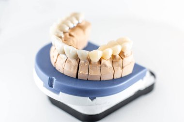 Dental imprint with artificial teeth