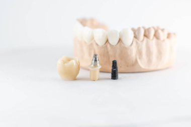 Model of artificial jaw and dental implant