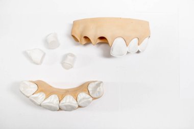 Plaster models of jaw fragment