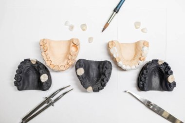 Artificial jaw models with dental implants clipart