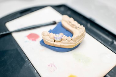 Colored dental prosthesis in the laboratory