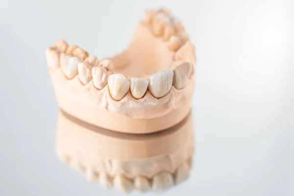 Model of artificial jaw with veneers — Stok fotoğraf