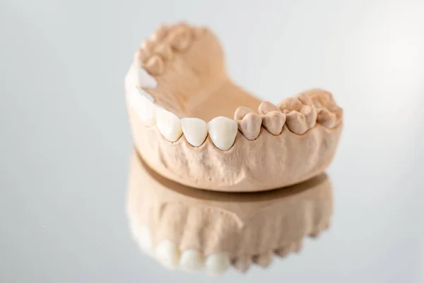 Model of artificial jaw with veneers — Stok fotoğraf