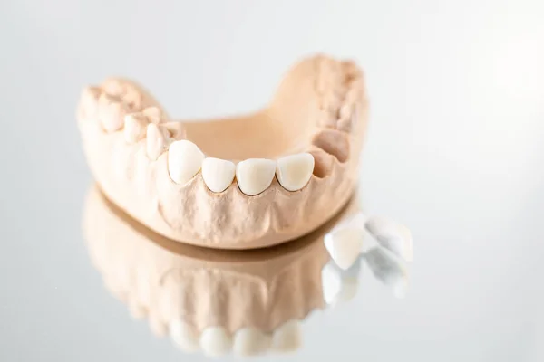 Model of artificial jaw with veneers — 图库照片