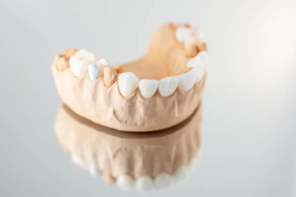 Modelo de mandíbula artificial com folheados — Fotografia de Stock