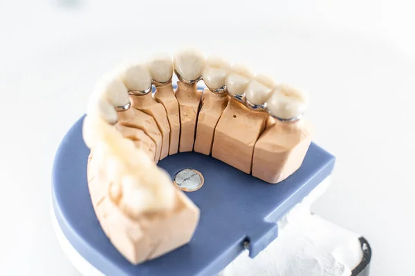 Dental imprint with artificial teeth — 图库照片