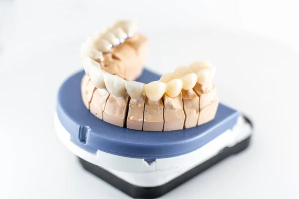 Отпечаток зуба с искусственными зубами — стоковое фото