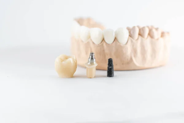 Model of artificial jaw and dental implant — Stok fotoğraf