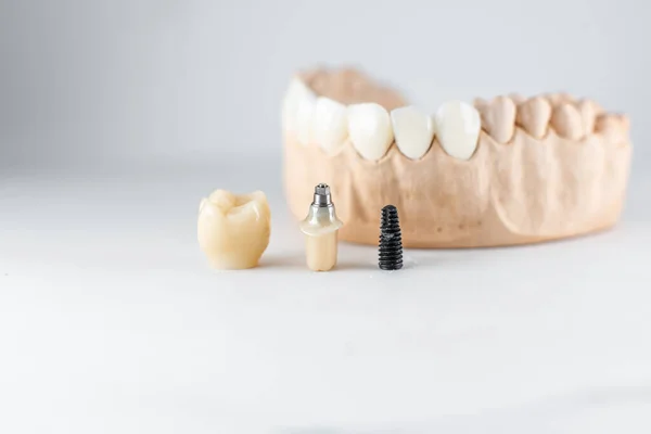 Model of artificial jaw and dental implant — Stok fotoğraf