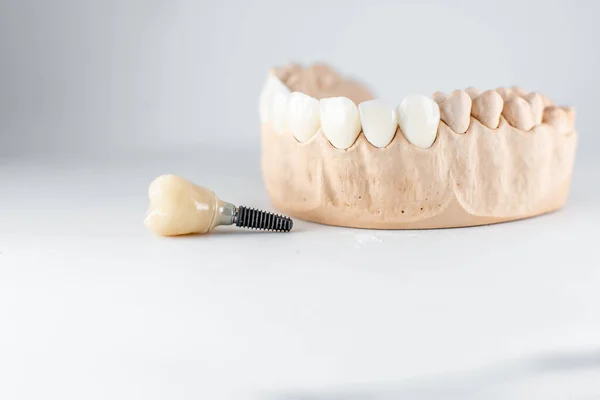 Modelo de mandíbula artificial e implante dental — Foto de Stock