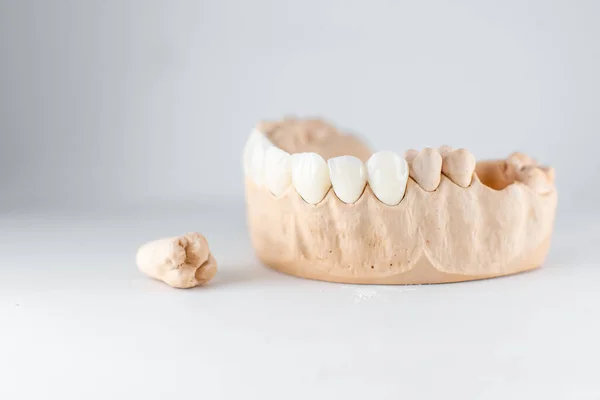 Модель искусственной челюсти и зуба на белом фоне — стоковое фото