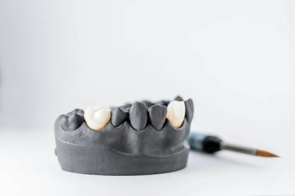 Model of artificial jaw with dental implant — Stok fotoğraf