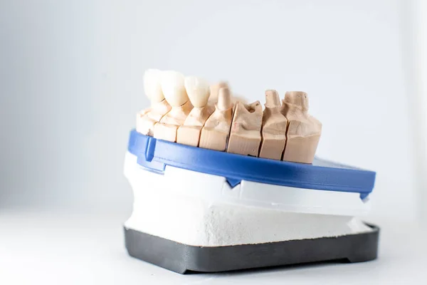 Impressões dentárias com dentes artificiais — Fotografia de Stock