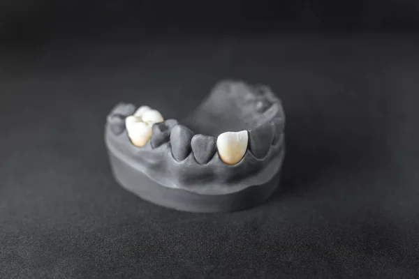 Model of artificial jaw with dental implant — Stok fotoğraf