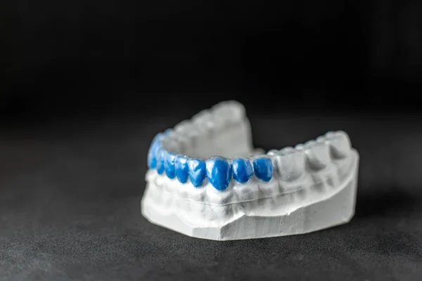 Искусственная челюсть с прозрачной зубной крышкой — стоковое фото