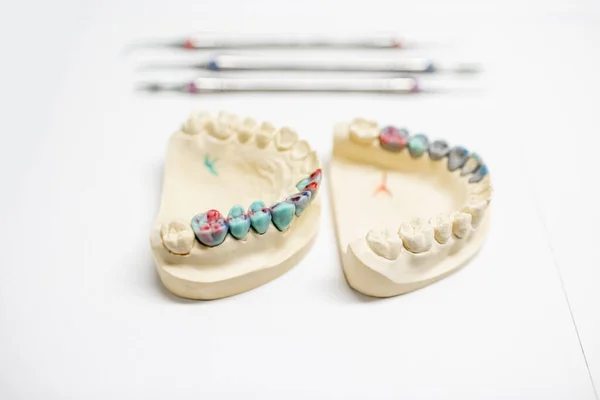 Искусственная челюсть с окрашенным зубным протезом — стоковое фото