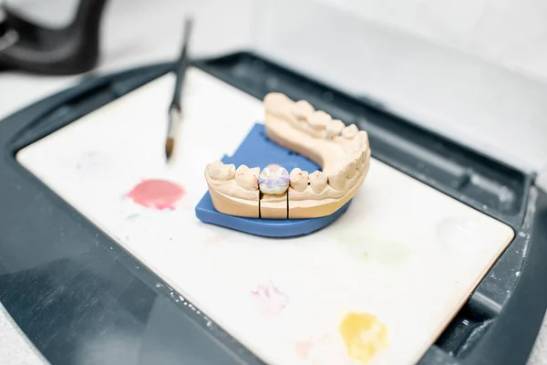 Prótesis dental coloreada en el laboratorio — Foto de Stock
