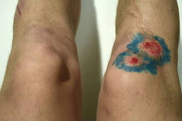 Bruise injury on young man knee. Close up image of male person sitting and examining wounded leg with fester. Wound infection concept. Wound in the male leg.