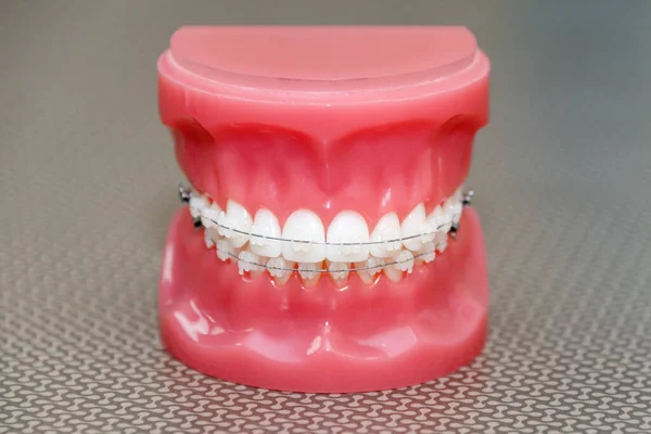 Orthodontic model and dentist tool - demonstration teeth model with ceramic braces on teeth on an artificial jaws closeup — Stock Photo, Image