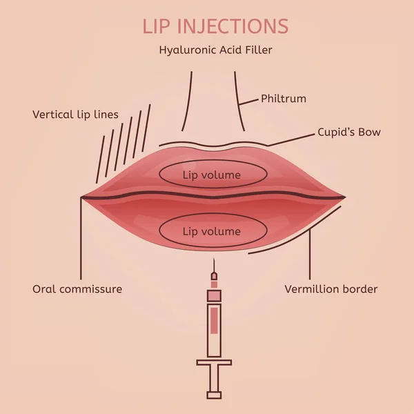 Lips Injections Image — Stock Vector