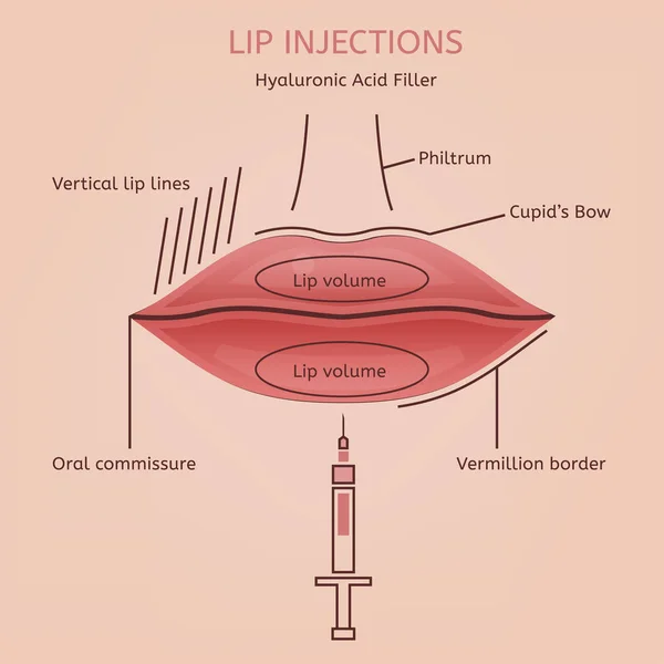 Inyecciones de labios Imagen — Vector de stock