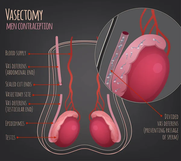 Man vasectomie afbeelding — Stockvector