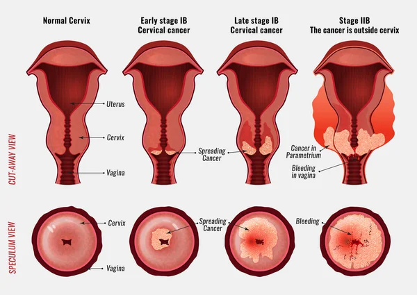 Imagen del cáncer cervical — Vector de stock