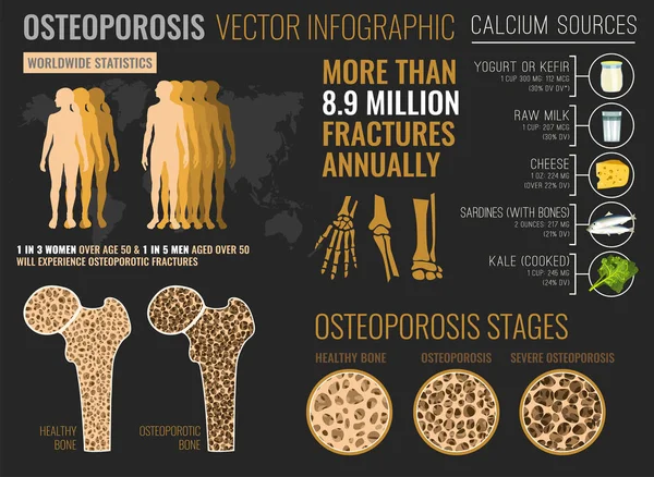 Osteoporóza Infographic plakát — Stockový vektor